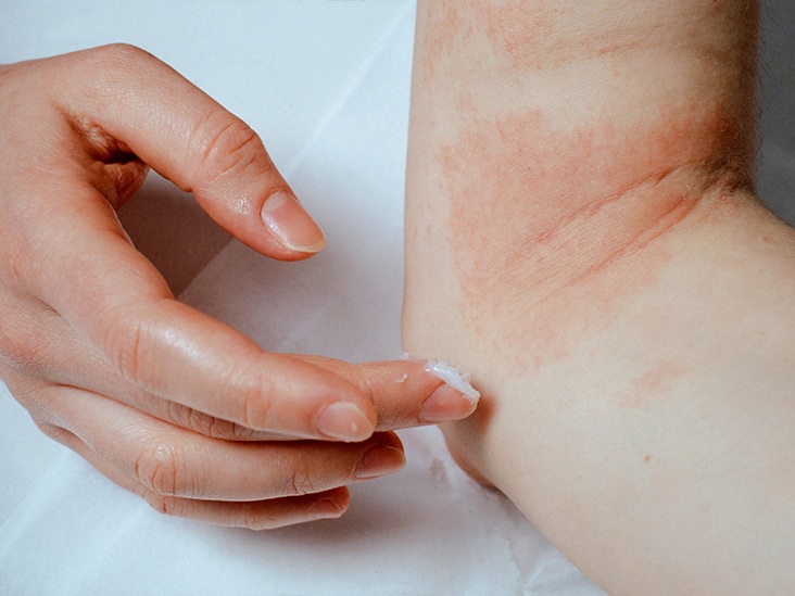 Normal Treatments for Eczema