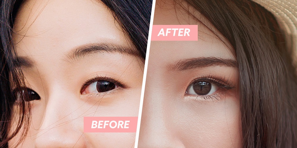 Is Double Eyelid Surgery The Most Trending Thing Now?