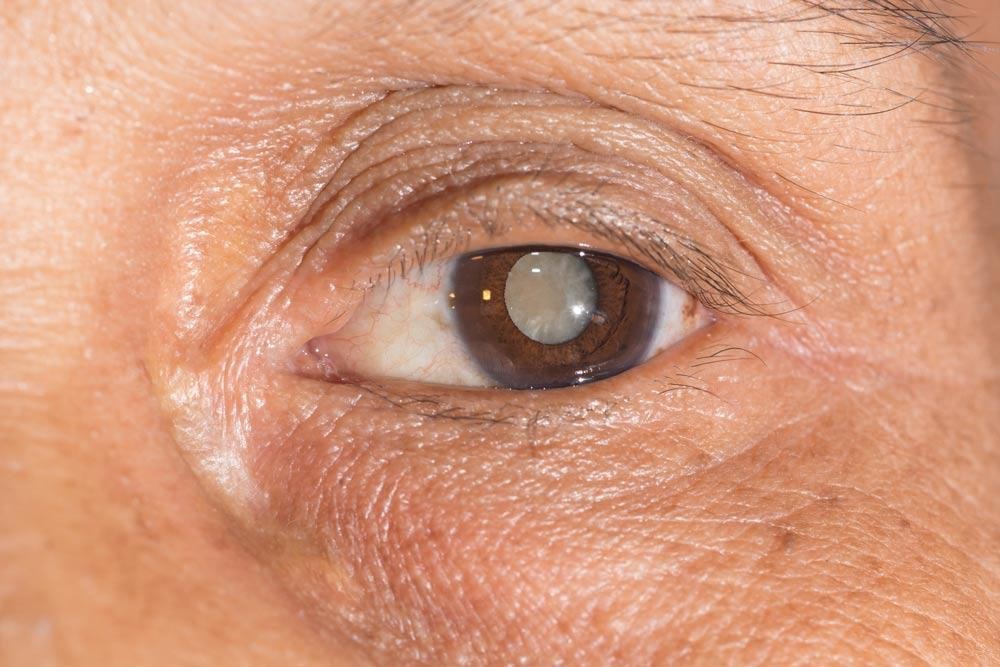 All You Need To Know About Cataracts: Causes, Symptoms, And Treatments