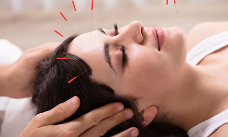Wellington Acupuncture: Get Rid of All Your Pain and Health Issues!