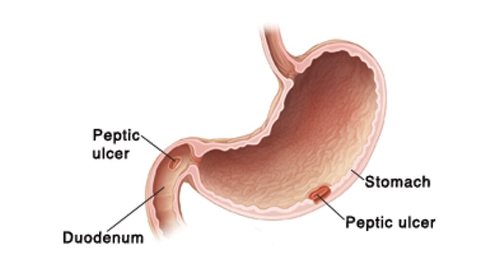 Why do stomach and duodenal ulcers occur?