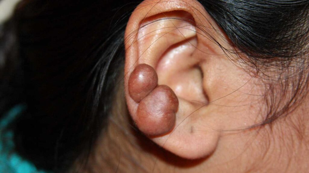 How do you get rid of ear keloids?