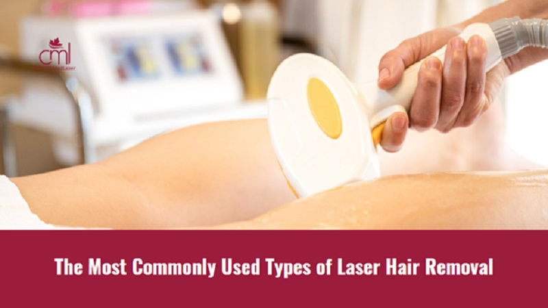 The Most Commonly Used Types of Laser Hair Removal
