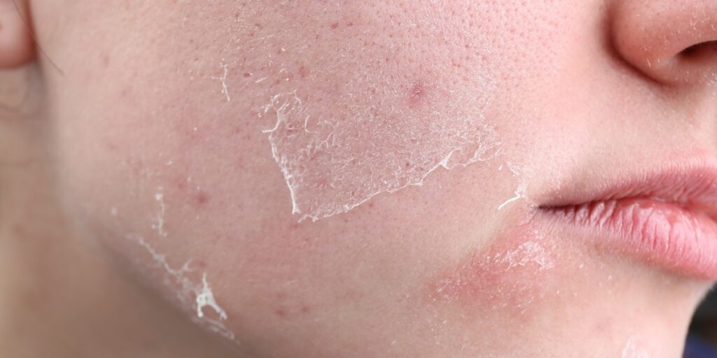 Understanding Dry Skin: Causes, Effects, and Solutions