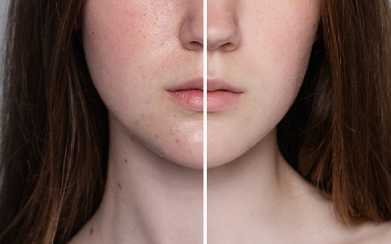 The Truth About Skin Pigmentation Treatment: Causes, Myths, and Solutions