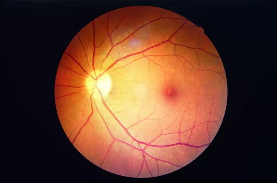 Stem Cell Treatment in India Offers Hope Beyond Conventional Treatments for Diabetic Retinopathy