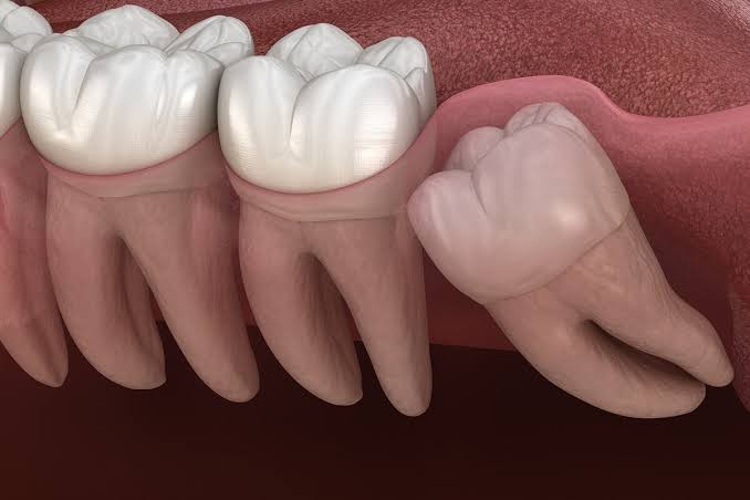 Wisdom Teeth Removal: When Should You Keep or Remove Your Wisdom Teeth?